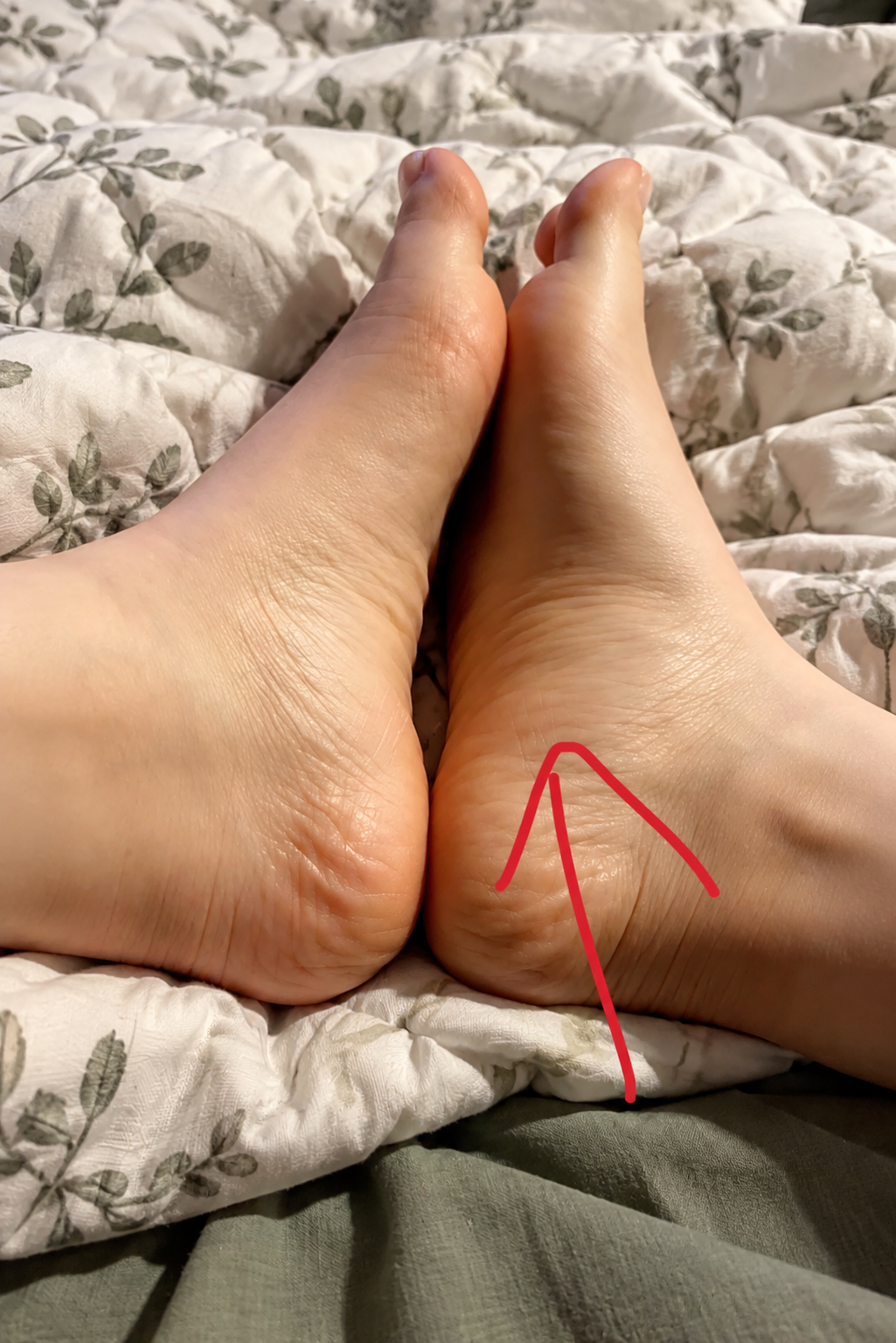 Deux talons nus sur une couette, une flèche rouge montre l'endroit douloureux